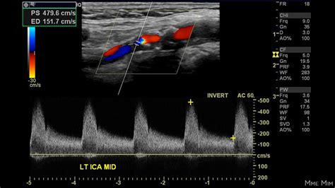 Carotid Artery Stenosis Chart Ultrasound