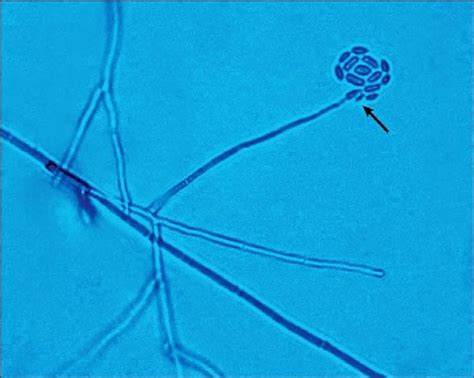 Macroscopic and Microscopic Characteristics of Ocular Fungal Isolates (Part 1) | Tuyenlab