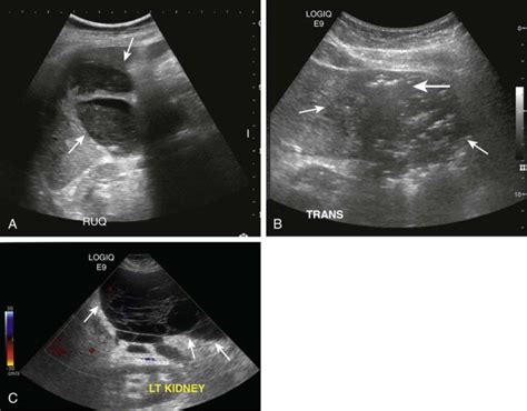 Abdominal Abscess | Radiology Key