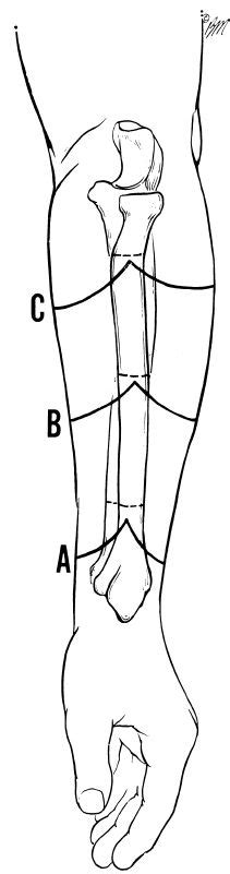 Fig 8A-3. Three levels of forearm amputation. | O&P Digital Resource ...