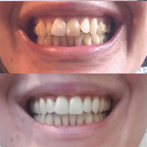 Before and after - 14 aligner trays and 13 refinement trays :D - finished today. : r/Invisalign