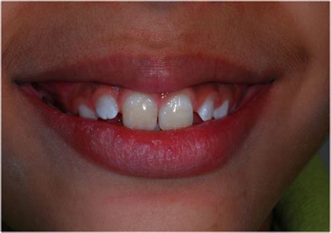 Restorative treatment on permanent teeth with enamel hypoplasia caused by trauma to the primary ...