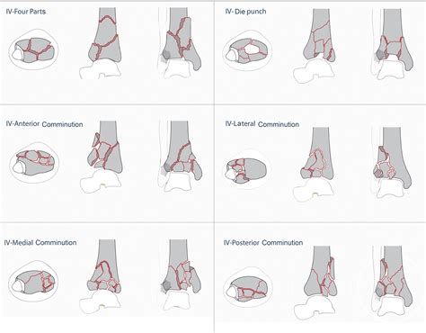 Pilon fractures: A new classification system based on CT-scan - Injury