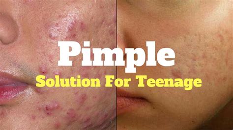 Acne Treatment For Teens