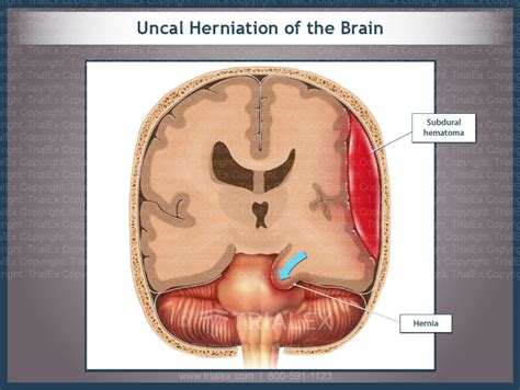 Uncal Herniation of the Brain - TrialQuest Inc.