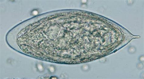 The eggs of Schistosoma haematobium | Medical Laboratories