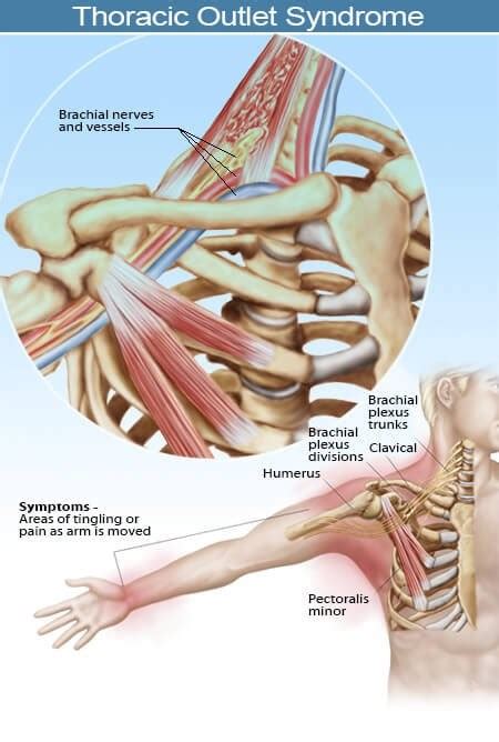 Case Study: Thoracic Outlet Syndrome – John Donohie CMT