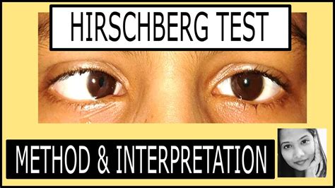 Hirschberg Test Explained |Squint simplified for medical students - YouTube