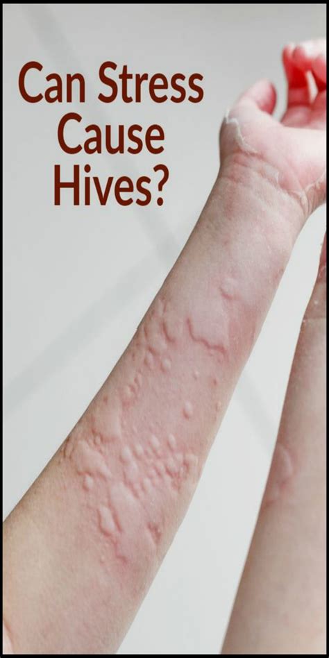 Can Stress Cause Hives? The Answer Is Complicated | Stress causes ...