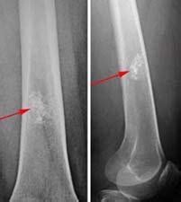 Enchondroma - OrthoInfo - AAOS