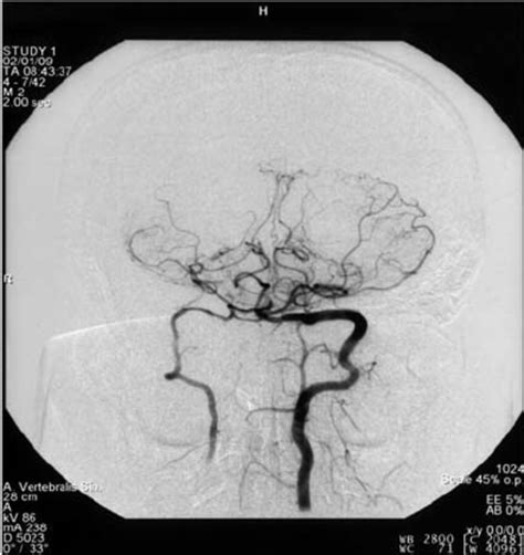 Digital subtraction angiography showed basilar artery occlusion in the ...