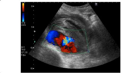 Doppler ultrasound of the right external iliac artery showing a 10.6 ×... | Download Scientific ...