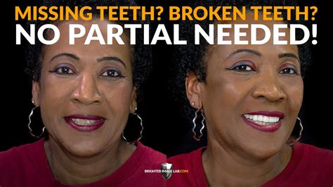 Dental Flippers, Partial Cost Too Much! See This Total Smile ...