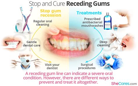 Natural Remedies For Receding Gums - change comin