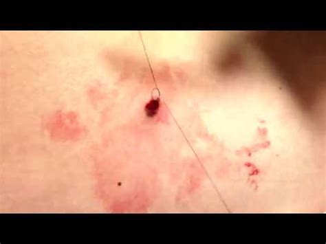 2mm PUNCH BIOPSY of atypical appearing mole (nevus). ABCDE of Melanoma ...