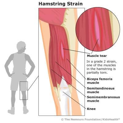 What is a Hamstring Strain?