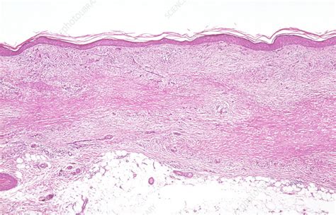 Necrobiosis lipoidica, LM - Stock Image - C050/1519 - Science Photo Library