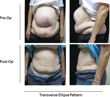 The partial underlay preperitoneal with panniculectomy repair for incisional abdominal hernia in ...