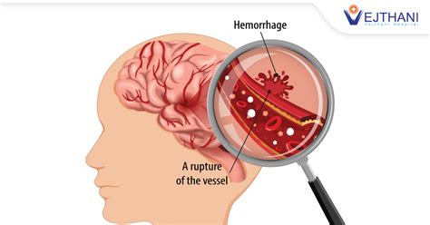 Brain Hemorrhage: What You Need to Know