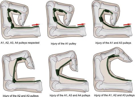 Injuries of the Flexor Tendons | Musculoskeletal Key