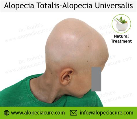 Alopecia Universalis