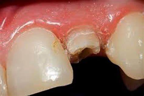 How to ensure a dental crown fits | Dispatch #7