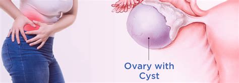 Types Of Cysts In Women