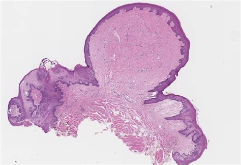 Irritation Fibroma Histology