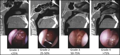 Agreement between cone-beam computed tomography and nasoendoscopy ...