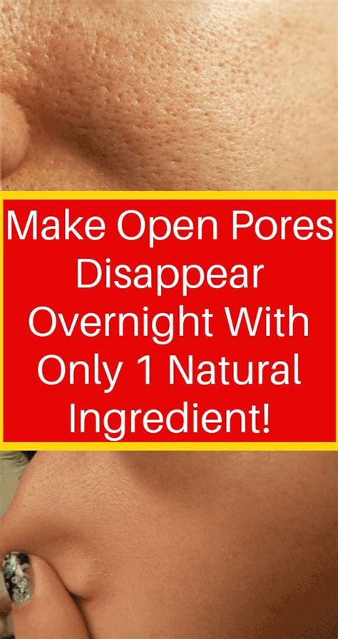 Get Rid Of Open Pores Naturally In Just 3 Days With These Powerful Home Remedies | Natural skin ...