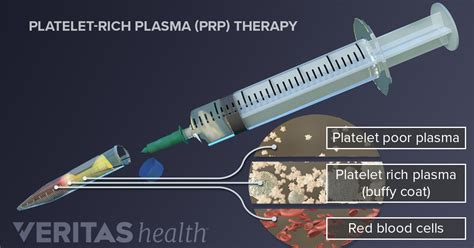 PRP Therapy for Chronic Tendon Injuries