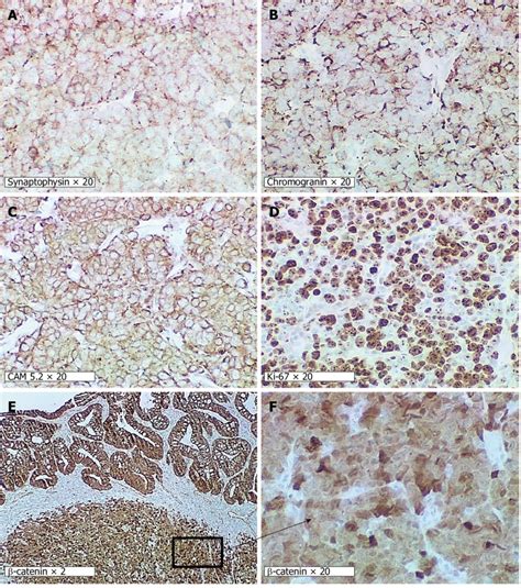 High-grade large-cell neuroendocrine carcinoma. Immunohistochemical ...