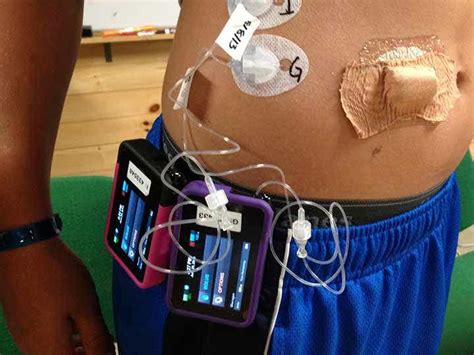 kutya Írógép Pillanat diy artificial pancreas Hozzájárulás sólyom Vetkőzz le