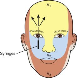 Supraorbital Nerve Block for Supraorbital Neuralgia | Musculoskeletal Key