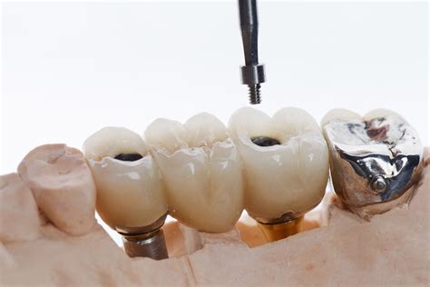 Implant-Supported vs. Traditional Bridges: A Comprehensive Guide