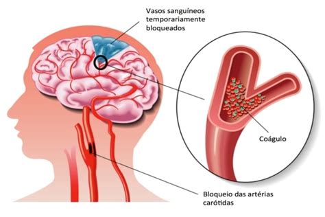 Isquemia Cerebral: Causas, Sintomas, Consequências e Tratamentos