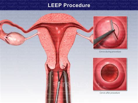 LEEP Procedure - TrialQuest Inc.