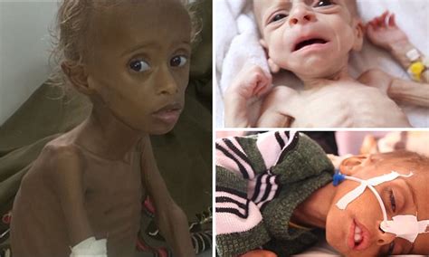 Over 2 million Yemen children are starving | Daily Mail Online