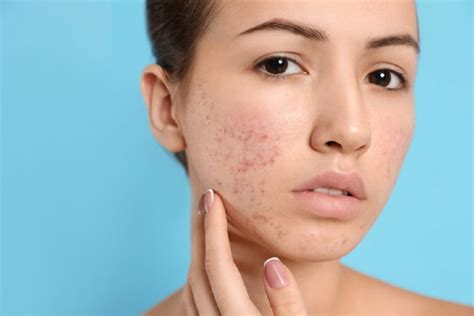 Best Acne Treatment For Sensitive Skin - Reaching World Live