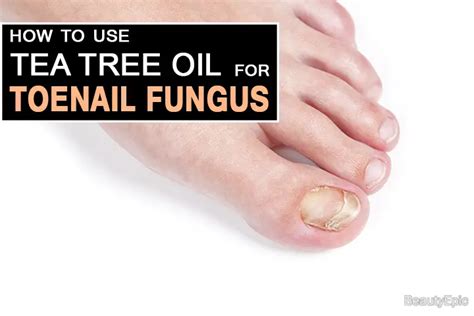 Tea Tree Oil To Treat Toenail Fungus And How To Use It