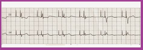 Float Nurse: EKG Rhythm Strip Quiz 186