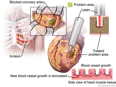 Nuclear Stress Test: Purpose, Procedure Patient Information, 46% OFF