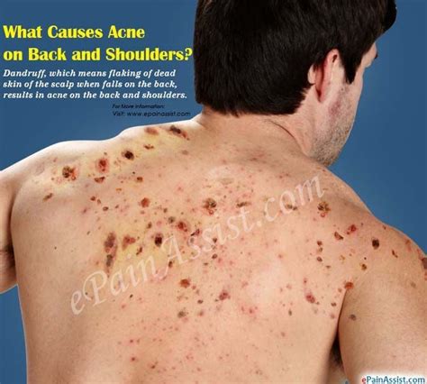 What Causes Acne on Back and Shoulders? | Shoulder acne, How to treat acne, Chest acne