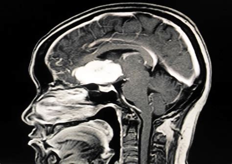 Premium Photo | Mri or ct scan brain rt.sphenoid ridge meninggioma