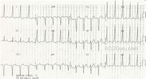 Delta wave | ECG Guru - Instructor Resources