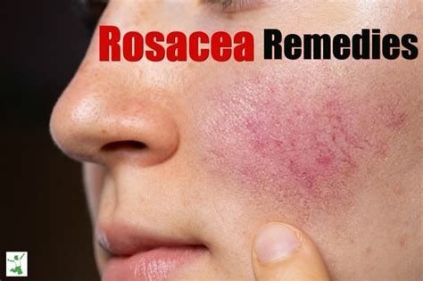 Natural Rosacea Remedies (+avoiding the #1 cause) | Healthy Home