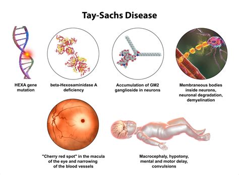 Tay Sachs Disease | The Stem Cellar