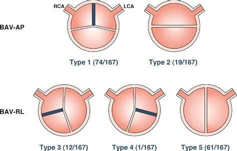 Association Between Bicuspid Aortic Valve Phenotype and Patterns of Valvular Dysfunction and ...