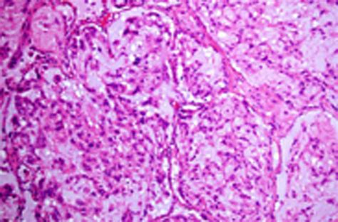 Epithelioid Hemangioendothelioma