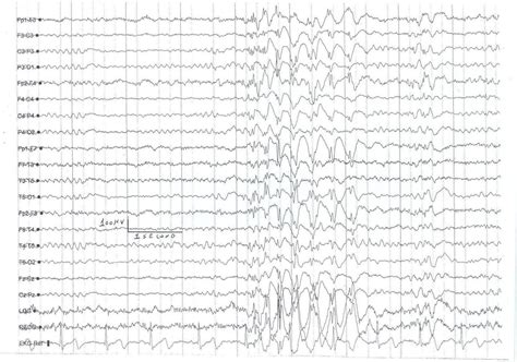 Juvenile Myoclonic Epilepsy: An Update | IntechOpen